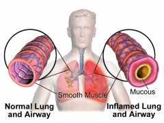 Illustration depicting bronchoconstriction