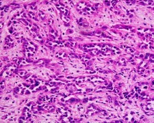 Poor to moderately differentiated adenocarcinoma of the stomach. H&E stain.