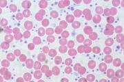 Blood smear of a myeloproliferative neoplasia patient with a significant increase in the number of platelets (purple) as compared to the clearly larger red blood cells. Ed Uthman/CC BY 2.0