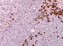 The picture shows pigmented cells of a malignant melanoma metastasis of the occipital lobe of the brain.