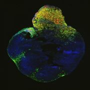 Neoplastic cerebral organoid with GFP-positive tumor regions (green), which demonstrates glioblastoma-like cellularity. IMBA