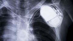 Cardiac pacemakers are usually housed in a titanium housing that is welded together from two parts. Empa has optimized the frequency of the working laser so that no black edges appear during welding, which would reduce the value of the medical product. Image: istockphoto